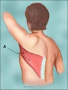 latissimus_dorsi_flap1[2]_tcm8-79047